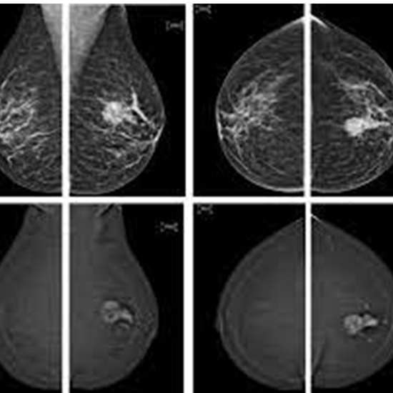 MRI Both Breasts With Contrast